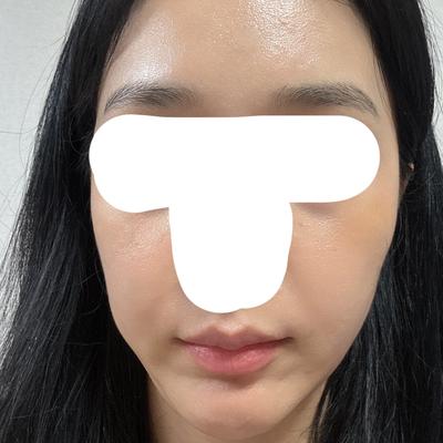 지방이식 6주차, 첫 지방이식인데 생착률 좋아서 대만족이에요 사진 3 — 아바성형외과 지방이식 후기