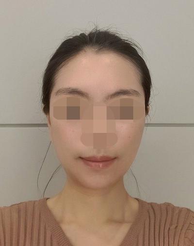안면거상 환자 후기 — 브라운성형외과 김승수 원장님... (340)