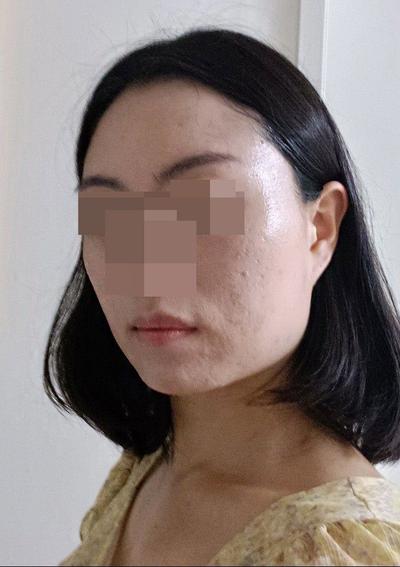 안면거상 9주차, 처진 얼굴살 올라가고 동안으로 돌아간 느낌 사진 2 — 아바성형외과 안면거상 후기