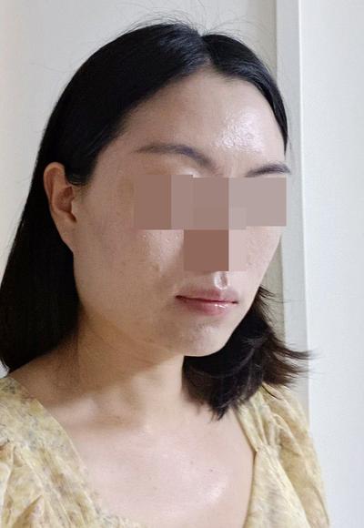 안면거상 9주차, 처진 얼굴살 올라가고 동안으로 돌아간 느낌 사진 4 — 아바성형외과 안면거상 후기