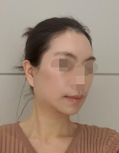 안면거상 9주차, 처진 얼굴살 올라가고 동안으로 돌아간 느낌 사진 5 — 아바성형외과 안면거상 후기
