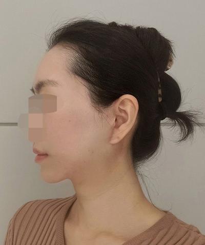 안면거상 9주차, 처진 얼굴살 올라가고 동안으로 돌아간 느낌 사진 6 — 아바성형외과 안면거상 후기