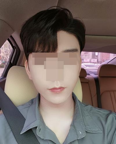 광대 사각턱 안면거상 재수술 한달차, 결과 매우 만족해요 — 아바성형외과 환자 후기 사진
