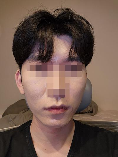 광대 사각턱 안면거상 재수술 한달차, 결과 매우 만족해요 사진 2 — 아바성형외과 안면거상 후기