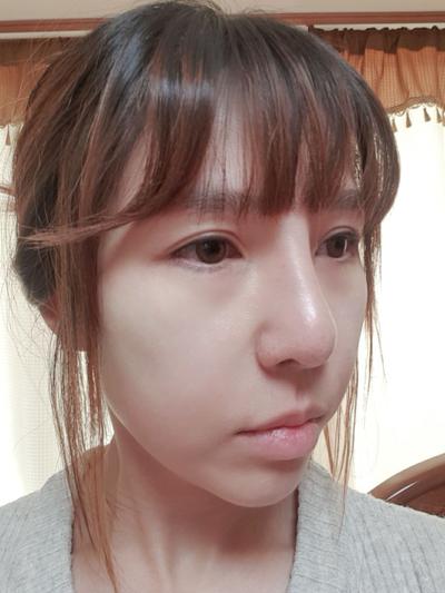 코성형 4개월차, 콧대랑 코끝 모양 너무 마음에 들어요 사진 3 — 아바성형외과 코성형 후기
