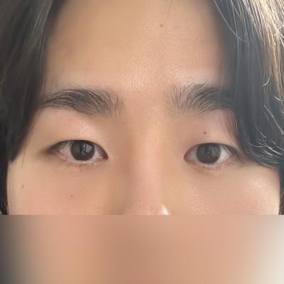 눈밑지방재배치 후기, 심했던 다크서클 거의 없어졌어요 — 아바성형외과 환자 후기 사진