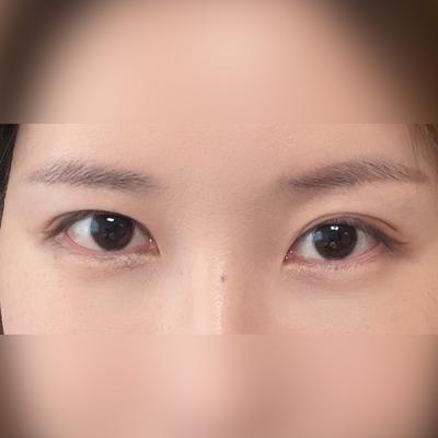 눈밑지방재배치 테이프 떼고 회복 빨랐고 눈밑 깔끔해졌어요 — 아바성형외과 환자 후기 사진