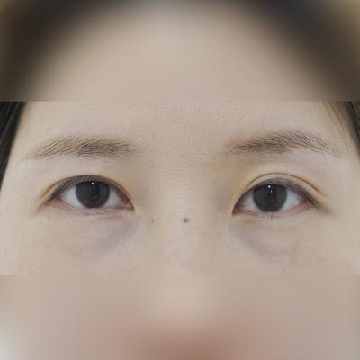 눈밑지방재배치 테이프 떼고 회복 빨랐고 눈밑 깔끔해졌어요 사진 2 — 아바성형외과 눈밑지방재배치 후기