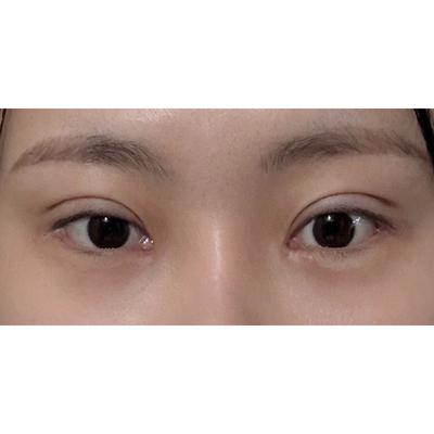 매몰 쌍꺼풀 눈재수술 4주차, 트임까지 하니 대만족이에요 — 아바성형외과 환자 후기 사진