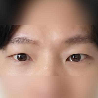 중안면거상＋눈밑지방재배치 8주차, 인상 밝아졌다는 말 정말 많이 들어요 — 아바성형외과 환자 후기 사진