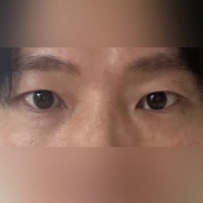중안면거상＋눈밑지방재배치 8주차, 인상 밝아졌다는 말 정말 많이 들어요 사진 2 — 아바성형외과 눈밑지방재배치 후기