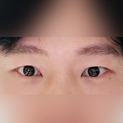수술 6주차, 딱 원하던 결과 나와서 너무 만족합니다 — 아바성형외과 환자 후기 사진