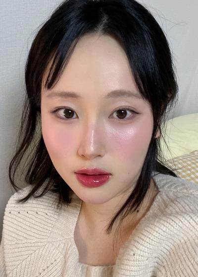 눈밑지방재배치 4주차, 인상 부드러워졌다는 말 많이 들어요 — 아바성형외과 환자 후기 사진