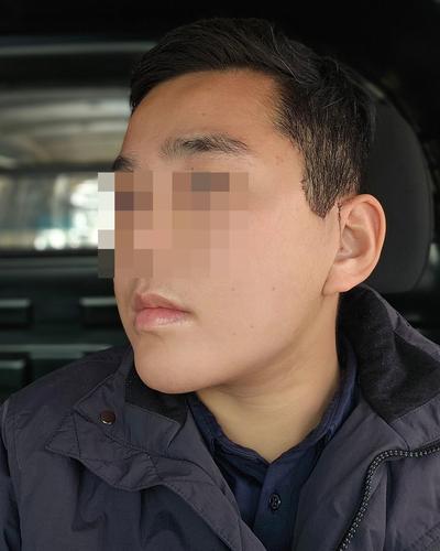 안면거상 환자 후기 — 양악수술을 받고 턱살이 너무... (350)