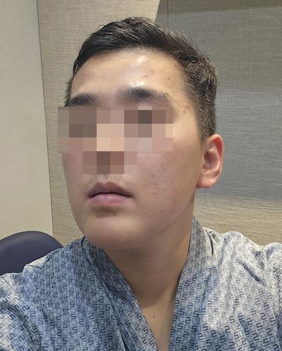 안면거상＋턱지방흡입 2주차, 이중턱 없어져서 후회 없어요 사진 3 — 아바성형외과 안면거상 후기