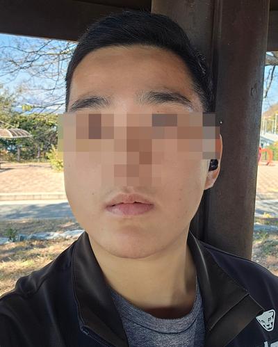 안면거상＋턱지방흡입 2주차, 이중턱 없어져서 후회 없어요 사진 4 — 아바성형외과 안면거상 후기