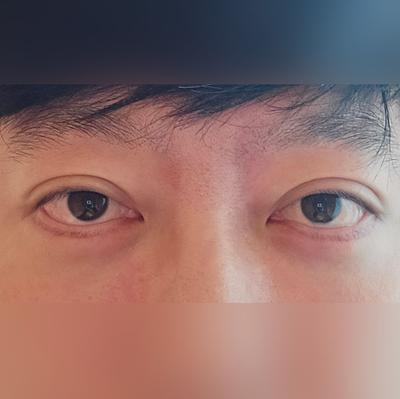 눈밑지방재배치＋하안검 4주차, 젊어졌다는 말 들어서 좋아요 — 아바성형외과 환자 후기 사진