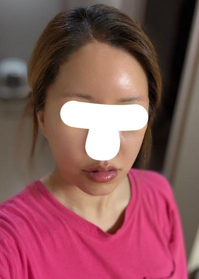 안면거상 환자 후기 — 얼굴 윤곽하고 아큐를했어요.... (352)