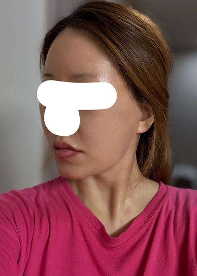 거상＋얼굴지방흡입 2개월차, 턱라인 확실히 정리됐어요 사진 5 — 아바성형외과 안면거상 후기