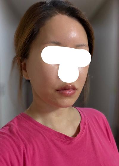 거상＋얼굴지방흡입 2개월차, 턱라인 확실히 정리됐어요 사진 6 — 아바성형외과 안면거상 후기