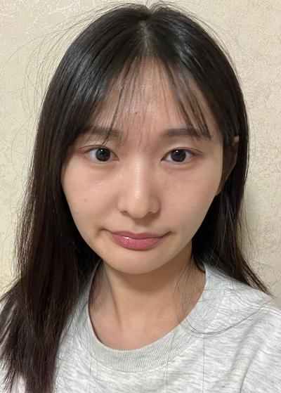 눈밑지방재배치 한 달, 짝짝이 굴곡 정리되고 눈가가 환해졌어요 사진 2 — 아바성형외과 눈밑지방재배치 후기