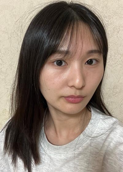 눈밑지방재배치 한 달, 짝짝이 굴곡 정리되고 눈가가 환해졌어요 사진 3 — 아바성형외과 눈밑지방재배치 후기