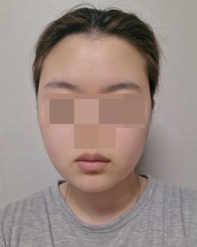 수술 8주차, 붓기도 통증도 다 사라져서 여기서 또 할 거예요 사진 4 — 아바성형외과 기타 후기