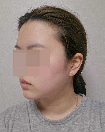 수술 8주차, 붓기도 통증도 다 사라져서 여기서 또 할 거예요 사진 5 — 아바성형외과 기타 후기