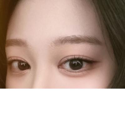 쌍꺼풀 앞트임 눈매교정 10주차, 셀카가 확 화려해졌어요 — 아바성형외과 환자 후기 사진