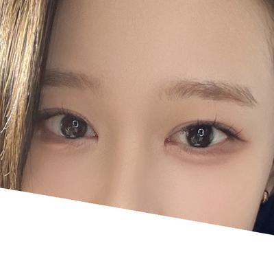 쌍꺼풀 앞트임 눈매교정 10주차, 셀카가 확 화려해졌어요 사진 4 — 아바성형외과 쌍꺼풀·눈성형 후기