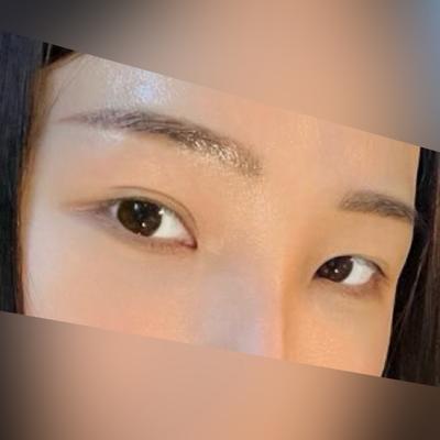 눈성형 환자 후기 — 눈밑 다크서클이 고민이였어서... (357)