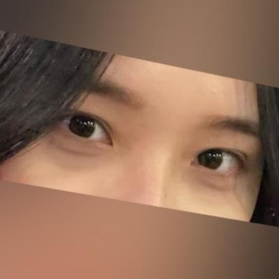 눈밑 다크서클 수술 2주차, 꺼진 부분 확실히 채워졌어요 사진 2 — 아바성형외과 눈밑지방재배치 후기