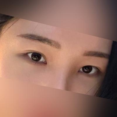 눈밑 다크서클 수술 2주차, 꺼진 부분 확실히 채워졌어요 사진 4 — 아바성형외과 눈밑지방재배치 후기