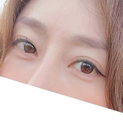 눈밑지방재배치 6주차, 사진 찍을 때마다 20대로 돌아간 느낌 — 아바성형외과 환자 후기 사진