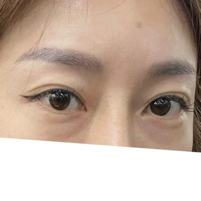 눈밑지방재배치 6주차, 사진 찍을 때마다 20대로 돌아간 느낌 사진 2 — 아바성형외과 눈밑지방재배치 후기