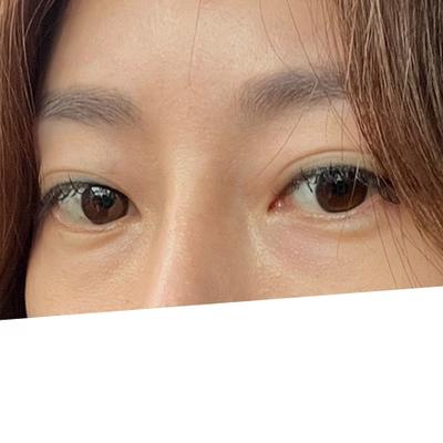 눈밑지방재배치 6주차, 사진 찍을 때마다 20대로 돌아간 느낌 사진 3 — 아바성형외과 눈밑지방재배치 후기