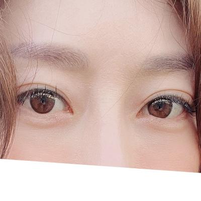 눈밑지방재배치 6주차, 사진 찍을 때마다 20대로 돌아간 느낌 사진 4 — 아바성형외과 눈밑지방재배치 후기