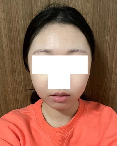 실루엣소프트 실리프팅 5주차, 처짐 고민 완전 해결했어요 — 아바성형외과 환자 후기 사진