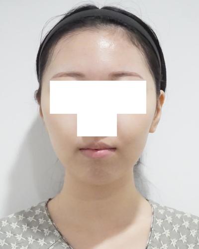 실루엣소프트 실리프팅 5주차, 처짐 고민 완전 해결했어요 사진 2 — 아바성형외과 안면거상 후기