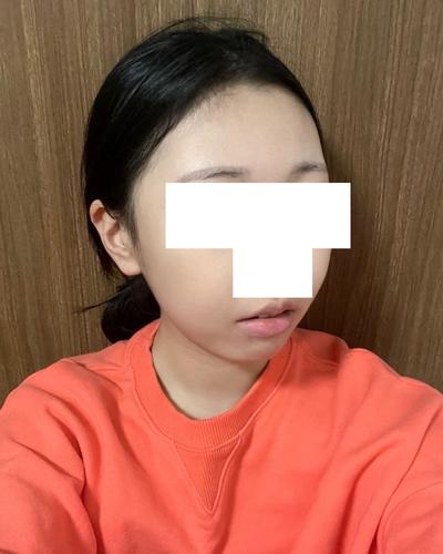 실루엣소프트 실리프팅 5주차, 처짐 고민 완전 해결했어요 사진 5 — 아바성형외과 안면거상 후기