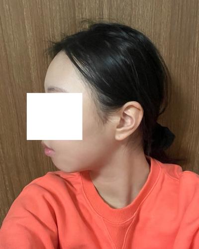 실루엣소프트 실리프팅 5주차, 처짐 고민 완전 해결했어요 사진 6 — 아바성형외과 안면거상 후기