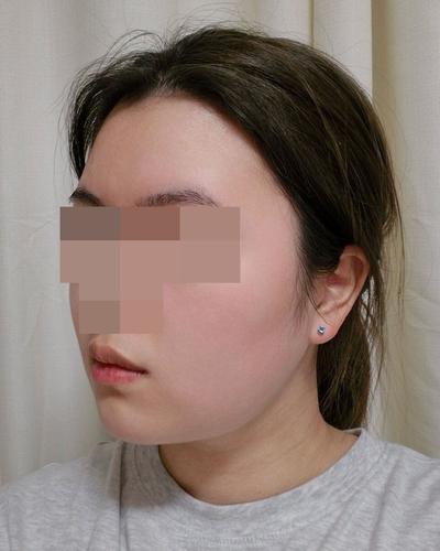 이중턱 지방흡입 2주차, 벌써 갸름해진 게 보여요 — 아바성형외과 환자 후기 사진