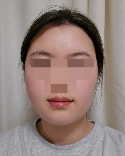 이중턱 지방흡입 2주차, 벌써 갸름해진 게 보여요 사진 5 — 아바성형외과 이중턱·윤곽 후기