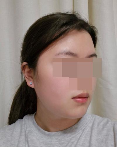 이중턱 지방흡입 2주차, 벌써 갸름해진 게 보여요 사진 6 — 아바성형외과 이중턱·윤곽 후기