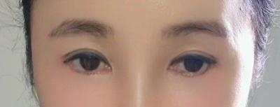 수술 2개월 넘긴 후기, 무탈하게 지내고 대만족입니다 — 아바성형외과 환자 후기 사진