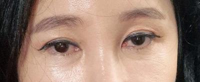 수술 2개월 넘긴 후기, 무탈하게 지내고 대만족입니다 사진 2 — 아바성형외과 기타 후기