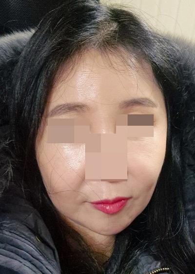 수술 2개월 넘긴 후기, 무탈하게 지내고 대만족입니다 사진 3 — 아바성형외과 기타 후기