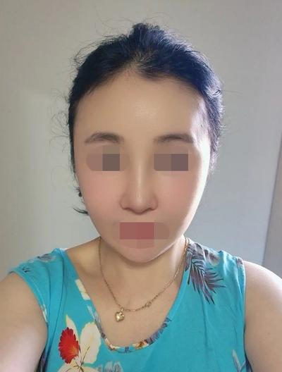 수술 2개월 넘긴 후기, 무탈하게 지내고 대만족입니다 사진 4 — 아바성형외과 기타 후기