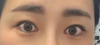눈 수술 9주차, 커지고 순해져서 분위기 있어졌다는 말 들어요 사진 4 — 아바성형외과 쌍꺼풀·눈성형 후기