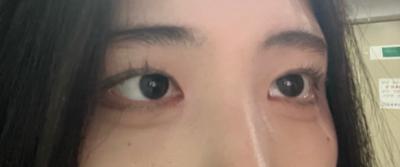 눈 감았다 뜨니 끝나 있었고 통증도 거의 없었어요 — 아바성형외과 환자 후기 사진